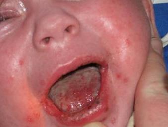 stomatitis ในทารกแรกเกิด