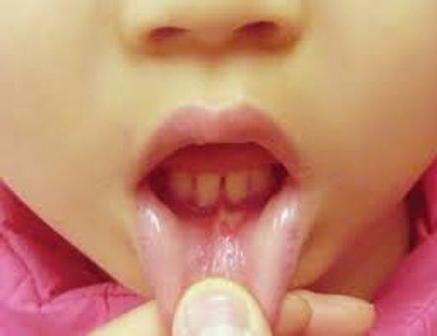 stomatitis ของเด็ก อาการของโรค