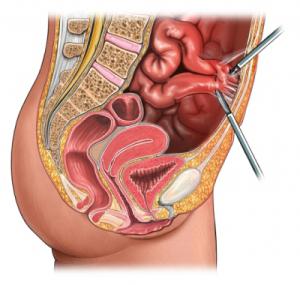 laparoscopy รังไข่