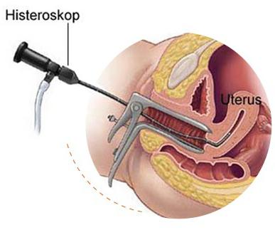 Hysteroresectoscopy - มันคืออะไร? วิธีการรักษาโรคทางนรีเวชน้อยที่สุด