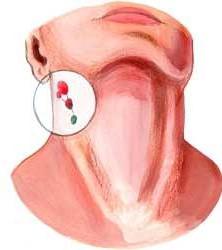 ชนิดของ angina คืออะไร?