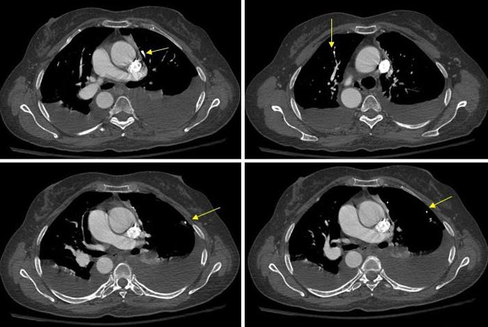 CT scan ของปอด - การวินิจฉัยที่ทันสมัย