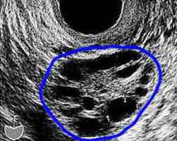 laparoscopy สำหรับรังไข่ polycystic