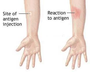 เป็นไปได้ไหมที่จะทำ Mantoux กับหวัดถ้าไม่มีอาการของโรคมากขึ้น?