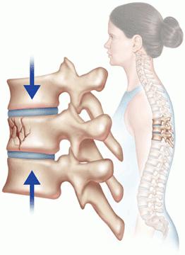 สาเหตุอาการและการรักษาอาการกระดูกสันหลังส่วนที่หักได้