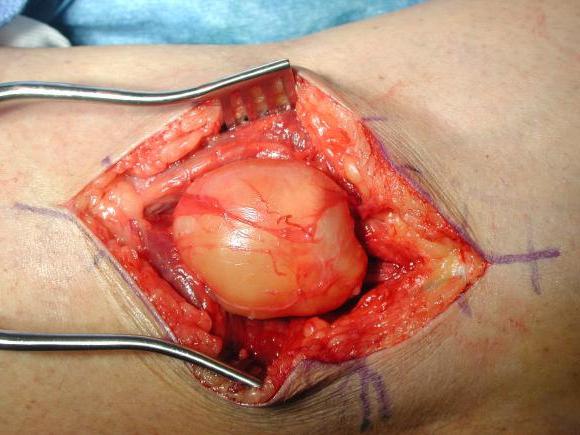 Sarcoma เป็นคำตัดสินหรือไม่? วิธีการจัดการกับโรค?