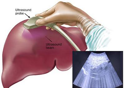 อัลตราซาวนด์ของตับ: การเตรียมการสำหรับขั้นตอนการบ่งชี้